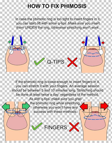 Phimosis – Circumcision Before and After